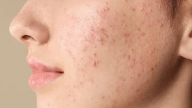 آکنه و لبنیات